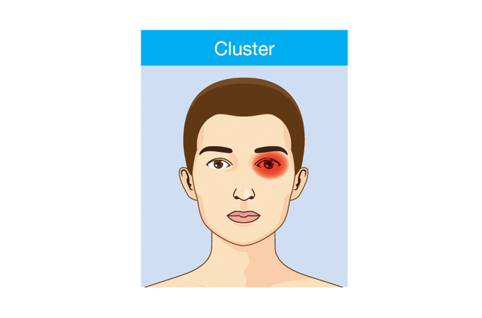 Cluster-Kopfschmerzen
